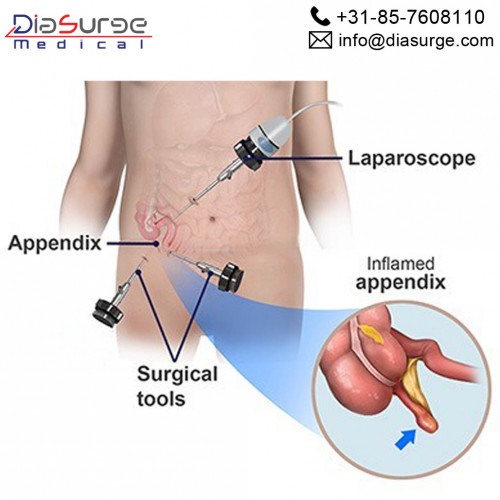Appendectomy is a laparoscopic surgical method that helps in treating the medical condition of Appendicitis. Appendicitis is a medical condition in which the appendix gets swelled up due to the infection and bacterial growth in the appendix. 

For more details about the laparoscopic surgeon device and endoscopic instruments, visit https://www.diasurge.com/