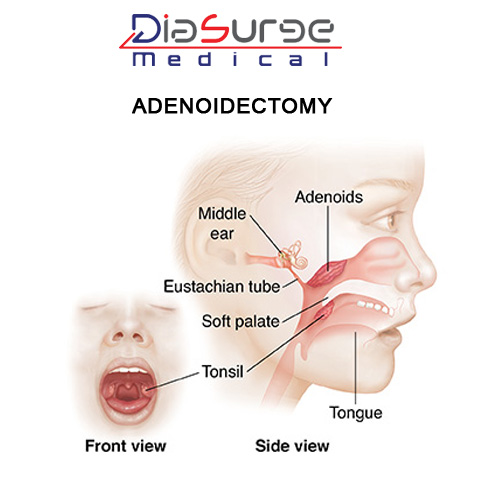 Adenoidectomy--endoscopic-surgery.jpg