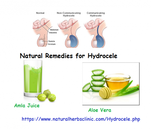 Aloe Vera and Amla Juice are very useful elements which widely used in Natural Remedies for Hydrocele. Take a cup of aloe vera and amla juice (in equal proportions) each morning on unfilled belly aid in hydrocele... https://www.naturalherbsclinic.com/blog/natural-remedies-for-hydrocele/