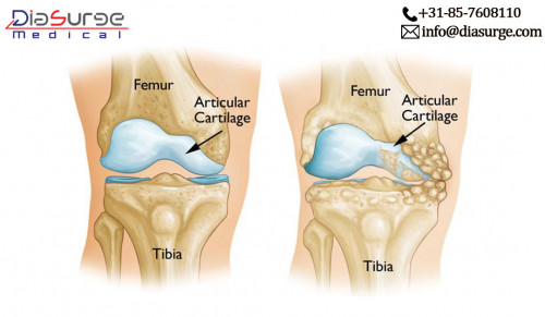 Cartilage is the name of the tissue which covers the joint bones of the human body so that the movement of the joints will be easier & frictionless. These are strong tissues but their wearing & tearing is very frequent due to injuries.
https://bit.ly/2BW6g90