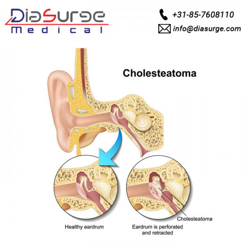Cholesteatoma is a medical condition in which an abnormal skin growth occurs in the middle section of the ear. This condition is caused by the regular ear infection or sometimes, it is hereditary. The endoscopic surgical procedure is performed to remove the Cholesteatoma from the patient's ear with the help of the endoscopic instruments.