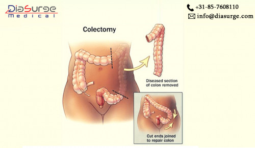 Colectomy is a laparoscopic surgery that is performed to diagnose colon bleeding, colon cancer, and other Chron's diseases. During the surgical procedure, the diseased section of the colon is removed. The laparoscopic surgery is performed with the help of laparoscopic surgeon devices and a surgical monitor.