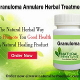 Granuloma-Annulare-Treatment632ea41b0454833f