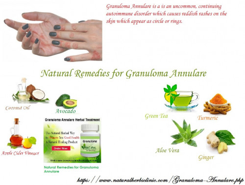 An individual can utilize distinctive Natural Remedies for Granuloma Annulare to acquire alleviation from this issue. Assuming beyond any doubt, you may attempt the accompanying homegrown cures... https://herbscareclinic.kinja.com/granuloma-annulare-a-provocative-skin-disease-1730969629