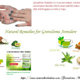 Granuloma-Annulare-and-its-Treatment-with-Natural-Herbal-Remedies