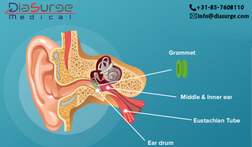 The insertion of Grommet in the ear of a person is used for treating the medical condition called Glue ear. The Grommet insertion helps in making air to enter the middle air so that the accumulation of fluid can stop. This condition is treated with the help of the 0-degree scope.