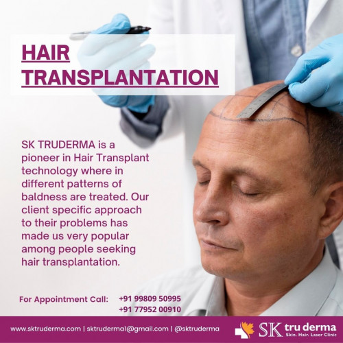 Hair-Transplantation-in-Sarjapur-Road-at-SK-Truderma.jpg