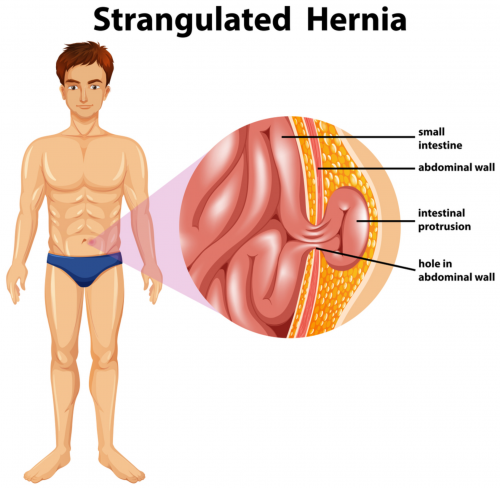 Hernia--3.png