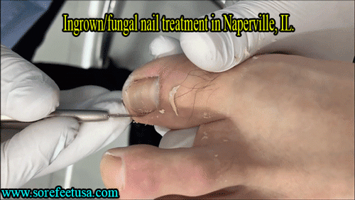 Ingrown fungal nail treatment in Naperville, IL.