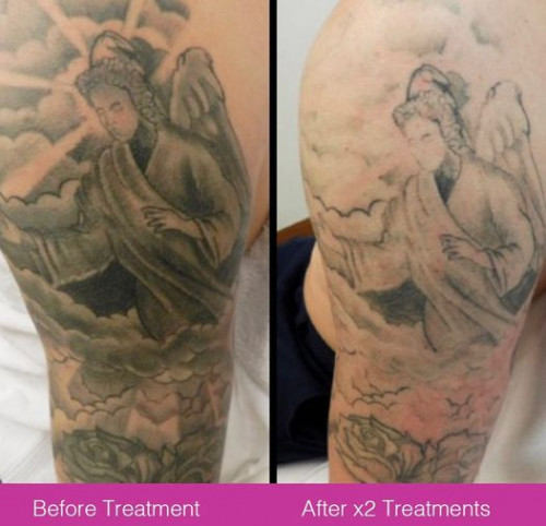 Is-Tattoo-Removal-Painful.jpg