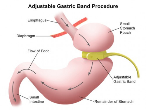 LAGB stands for Laparoscopic Adjustable Gastric Banding which is a laparoscopic surgical procedure for weight loss. If you have tried everything from working out to dieting but still you are unable to lose your weight, then this bariatric surgery could be your solution. It helps you in reducing severe obesity which leads to many dangerous diseases such as high cholesterol, arthritis, type 2 diabetes, apnea, hypertension, etc. 

https://bit.ly/3hIxrUF