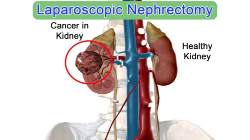 The Laparoscopic Nephrectomy is less painful as compared to normal surgeries and the recovery time is also very less...
Visit here:- https://bit.ly/39wKV2a