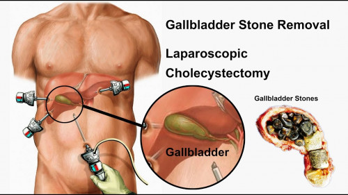 Laparoscopic cholecystectomy is a laparoscopic surgery that is performed with the help of various small incisions into the abdomen. This surgery is performed for removing the gallbladder of a person. 
To get more information:- https://bit.ly/3hDLtqO