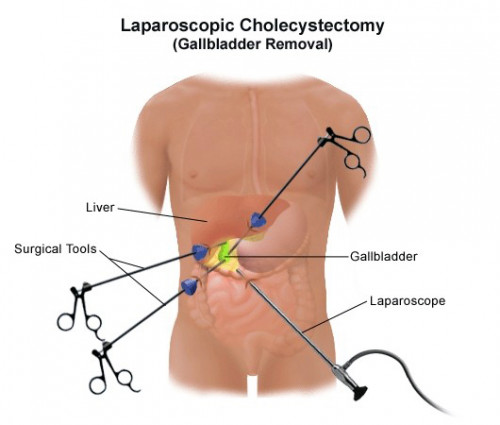 Laparoscopic Cholecystectomy is a laparoscopic surgical procedure for removing Gallbladder. It is a minimally invasive surgery that is performed through minimally invasive surgery devices which involves small incisions to remove the gallbladder.