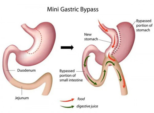 laparoscopic mini gastric bypass helps in dividing the stomach into two parts, upper and lower pouches. so, that the small intestine can be rerouted and the surgery can be performed.