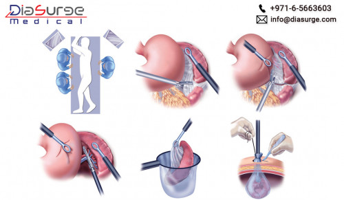 Laparoscopic Splenectomy is a laparoscopic surgical procedure that is performed through laparoscopy surgeon devices. In this surgical procedure, the spleen is removed when the artery expands abnormally and the spleen gets blocked.