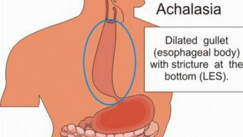 Natural Remedies for Achalasia are enough in get rid of Achalasia completely.  However they can give relief from the symptoms caused by this disease... http://naturalherbsclinic.over-blog.com/2015/09/achalasia-an-uncommon-infection.html