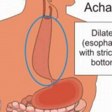 Natural-Remedies-for-Achalasia