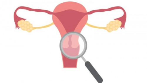 Intramural leiomyoma of the uterus can cause symptoms like heavy periods, pelvic pain, and infertility. Learn about its causes, diagnosis, and treatment options, including medication, minimally invasive procedures, and surgery. Discover how managing these uterine fibroids can improve your overall health and quality of life. For more information, please visit: https://www.usafibroidcenters.com/blog/what-are-intramural-fibroids-and-how-do-you-treat-them/