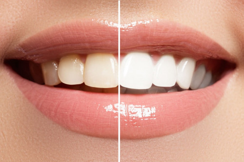 Teeth-Whitening-The-Easiest-Cosmetic-Dental-Procedure-to-Improve-Your-Smile.jpg