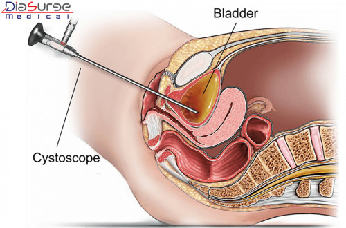 The 0-degree scope is a nasal endoscope which is used for providing detailed images to the surgeons during the surgeries of nasal procedures, sinus, therapeutic, and diagnostic. The 0-degree scope helps in providing the detailed image of the straight view into the nose of the patient. 
Visit for more information:- https://bit.ly/2MMtksw