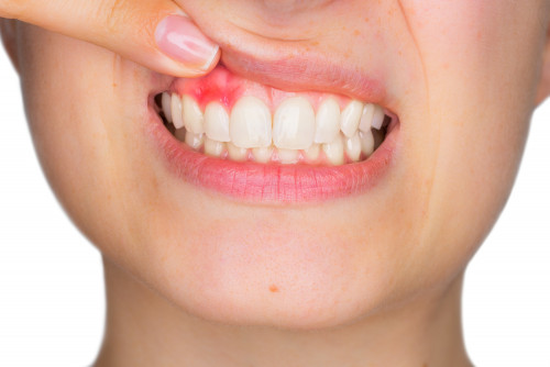 Ways-to-Stop-Bleeding-Gums.jpg