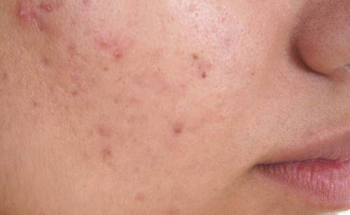 acne-scarring_636649368123472400_109427.jpg