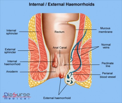 Minimal invasive surgery for hemorrhoids
