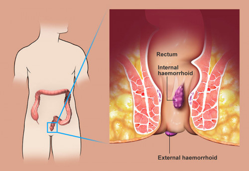 Hemorrhoids are not considered to be a dangerous disease. However, if you are dealing with continuous pain and discomfort in the anus, then it should be treated soon. Some medications will also help you but if the problem is serious, then it is better that you should go for the surgical procedure. Minimally invasive surgery through an endoscope is one of the most effective ways of treating Hemorrhoids nowadays and also providing us better results.
Visit More:- https://bit.ly/39k4QBD
