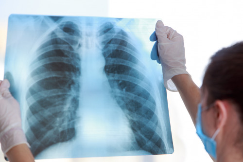 Doctor examines an X-ray of a lung