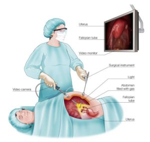 laparoscopy-surgery.jpg