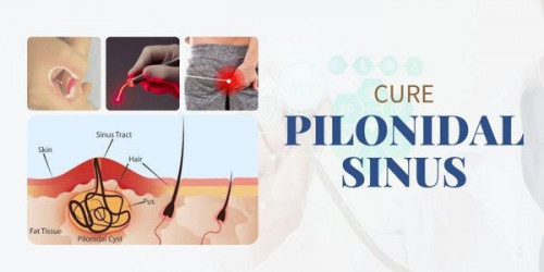 The pilonidal sinus surgery is very well treated with laser surgery. Get the best help from laser specialists with a fine clinic and have perfect healing.
https://laser360clinic.com/find-out-a-marvelous-pilonidal-sinus-surgery-through-laser/