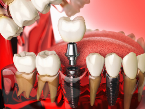 Advanced dental specialists is consider to be the best Dental Implants near Berkeley Heights NJ. We provide modern dental experience complete with latest equipment and technology than can give you the feel of Painless Dental Care. Visit our Website https://www.adsorthodontics.com/.