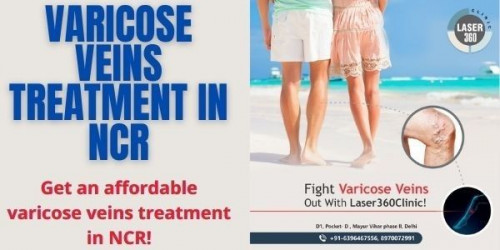 varicose-veins-treatment-ncr.jpg